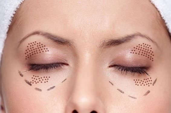 Cắt Mí TrênDưới + Ghép Mỡ.jpg