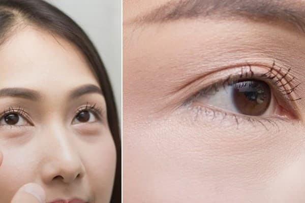 Cắt Mí Trên DướiLấy Mỡ.jpg