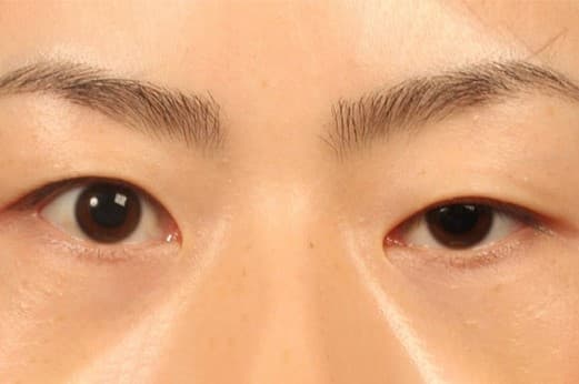 Chỉnh Sụp Cơ Nâng Cơ Mi.jpg