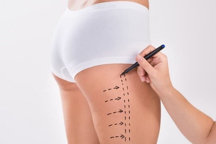 Hút Mỡ Đùi Trên 65kg.jpg