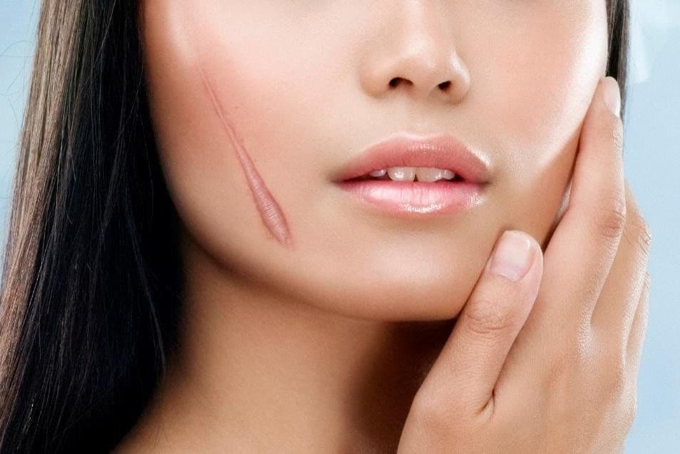 Sửa Sẹo Xấu 1.jpg