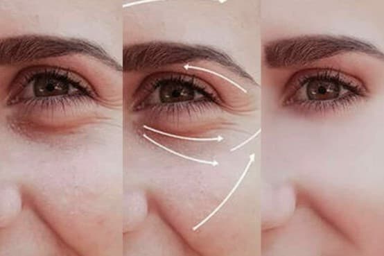 Xóa Rãnh Lệ + Lấy Mỡ Bọng Mắt.jpg