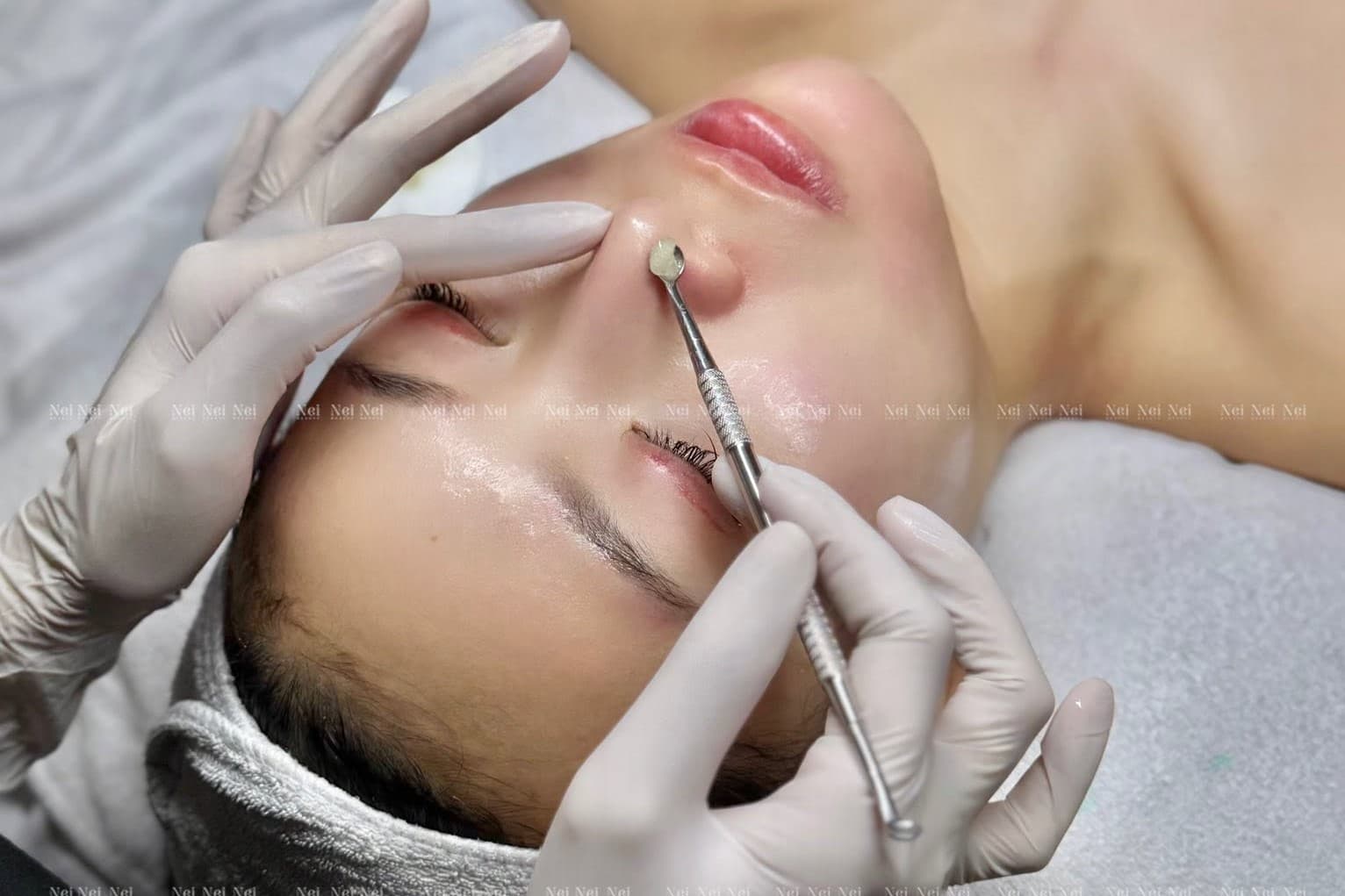 lấy nhân mụn mặt.jpg