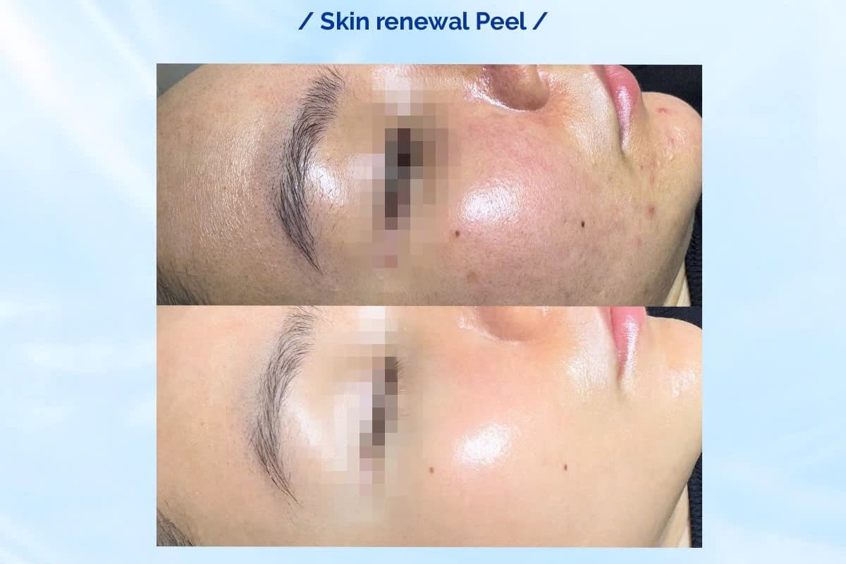 peel.jpg