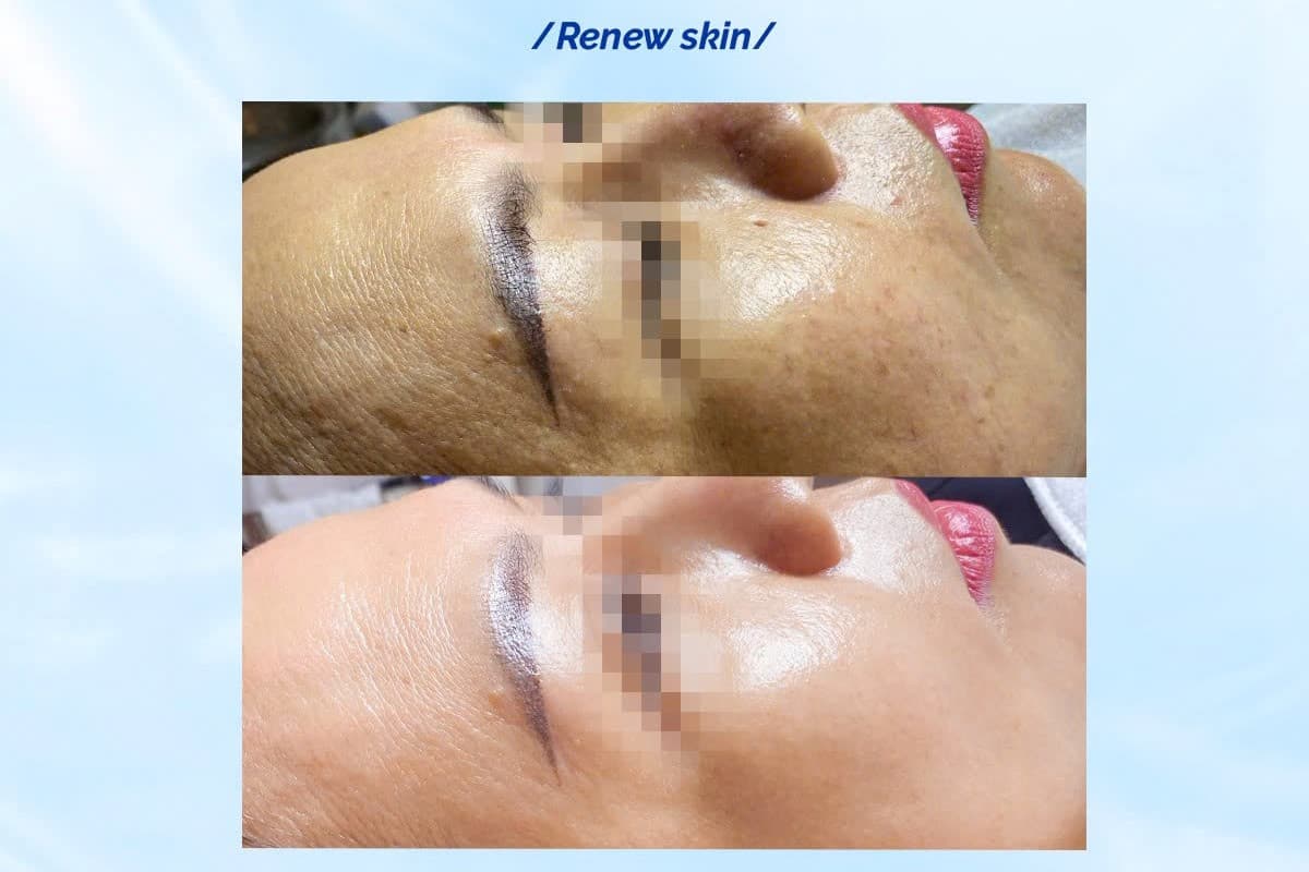 peel da dầu.jpg