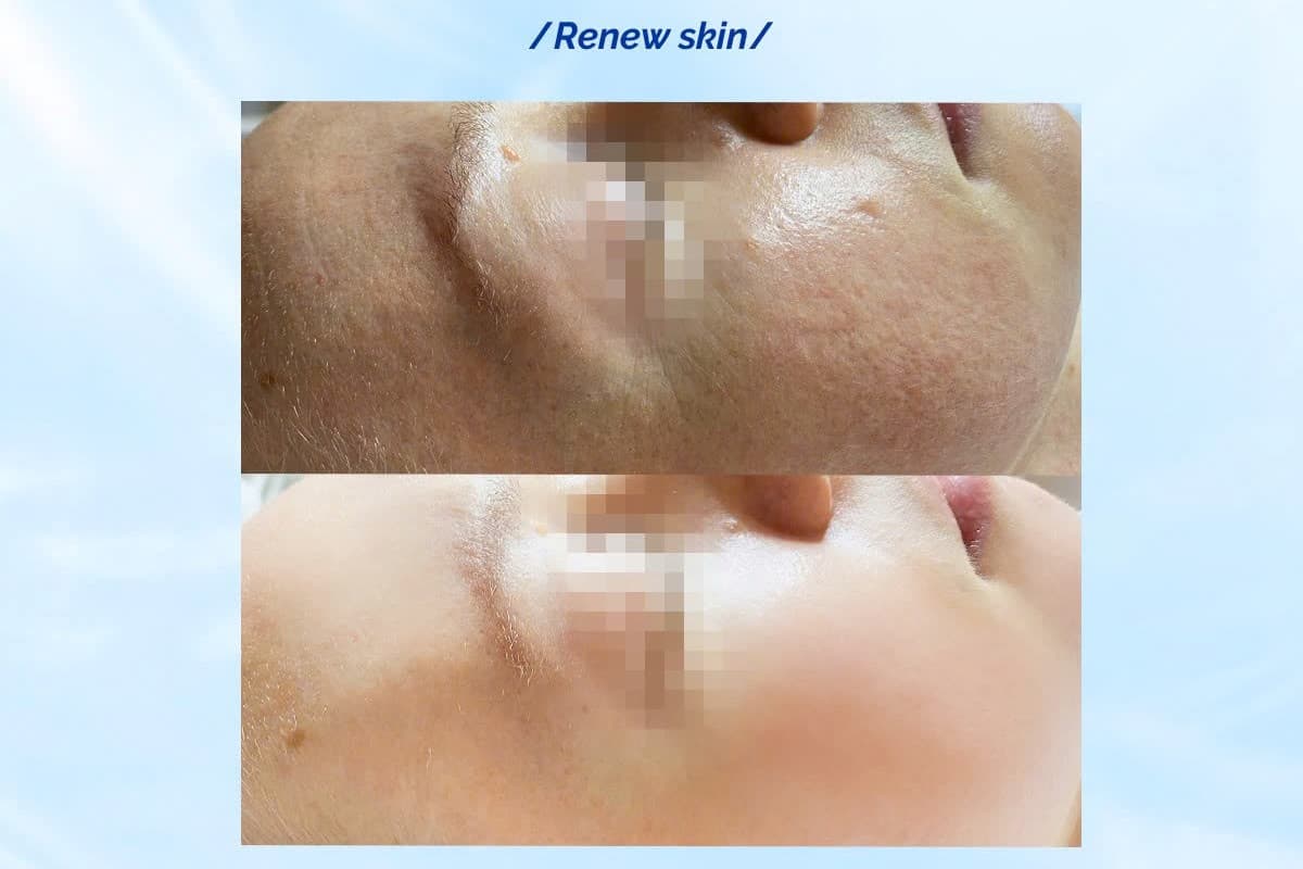 peel nhạy cảm.jpg